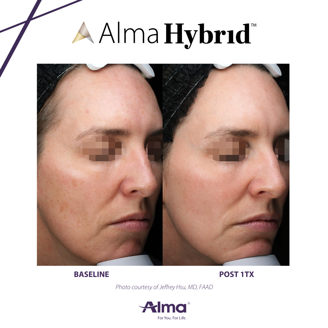 Alma Hybrid Resurfacing Laser Ageless Esthetics Medspa